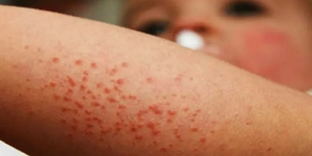 SINALOA, CON FACTORES QUE INCREMENTAN EL RIESGO DE PROPAGACIÓN DEL SARAMPIÓN