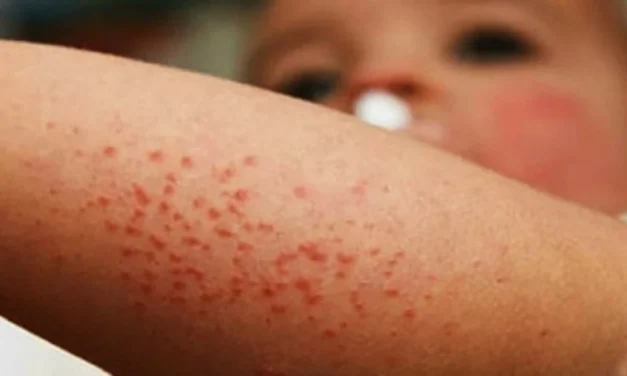 SINALOA, CON FACTORES QUE INCREMENTAN EL RIESGO DE PROPAGACIÓN DEL SARAMPIÓN